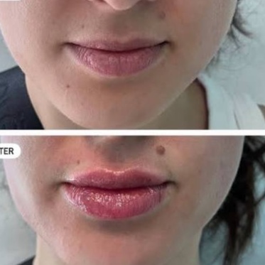 Lip Quench™ Hydration Treatment at Ultimate Health Spa in Leesburg, FL