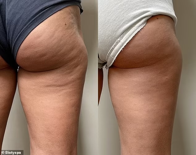 Bye Cellulite at Divine Sculpting in Arvada, CO