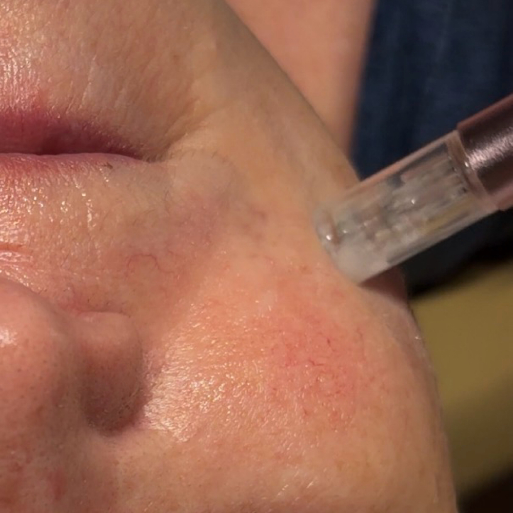 Microneedling • Carissa at Vibez & Vanity Salon in Tucson, AZ