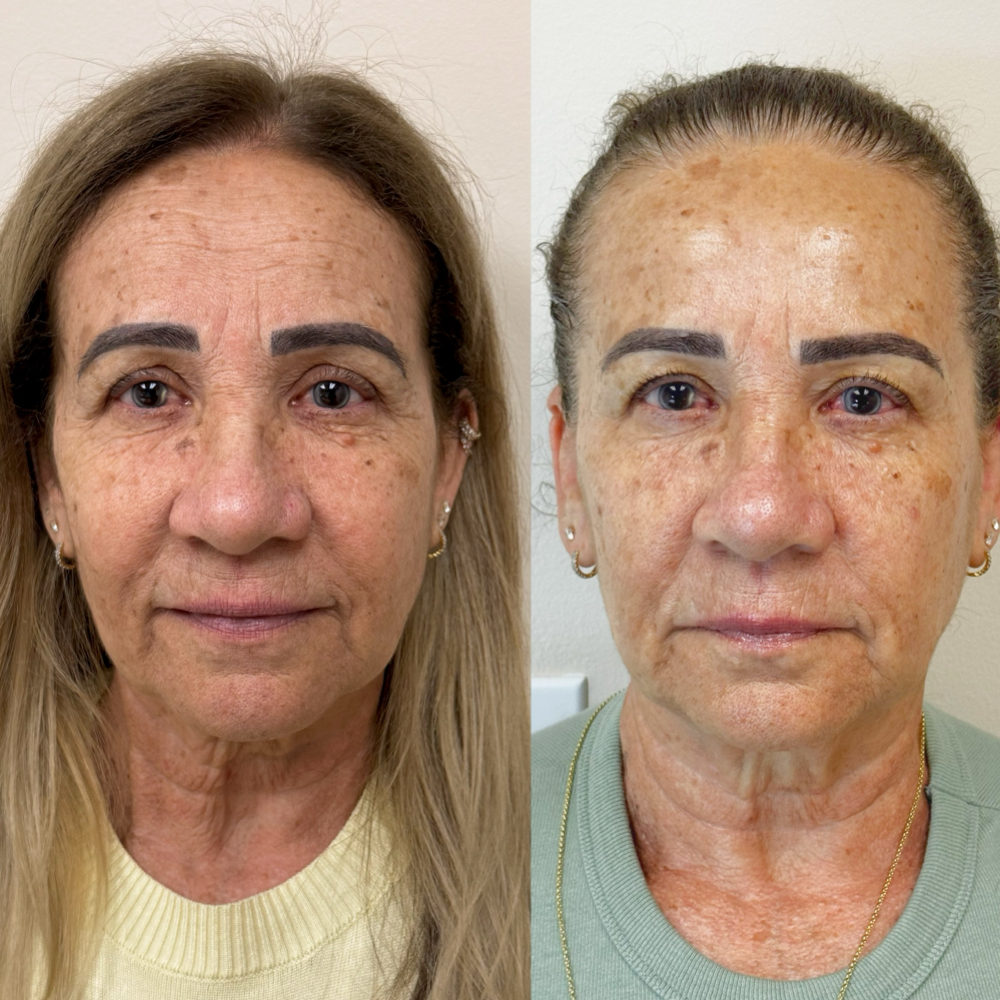 Concept Regenera Skin Protocol at Taiane Alvarenga Concept in Woburn, MA