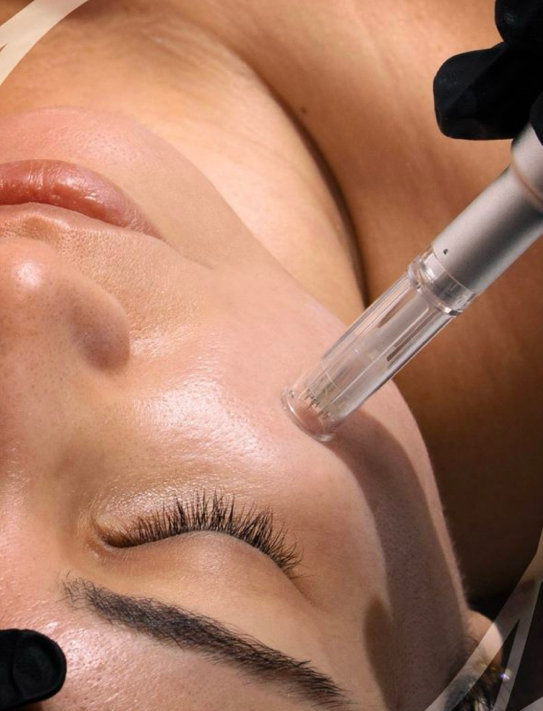 Microneedling Facial