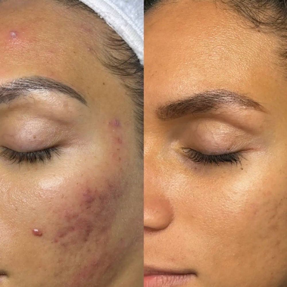 Acne Signature Facial at Jubee Boutique MedSpa in Annapolis, MD