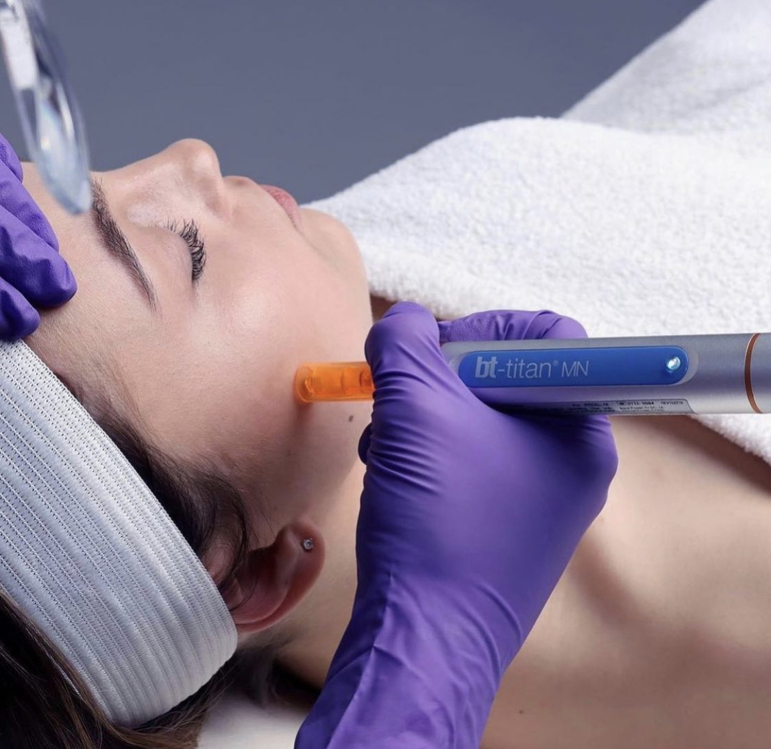 Micro-Channeling Treatment