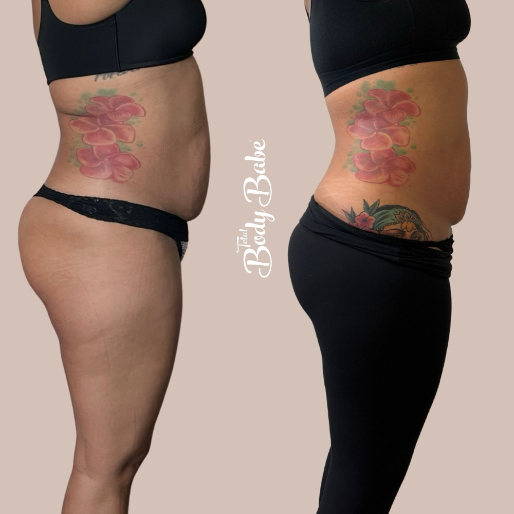 Stomach Sculpting