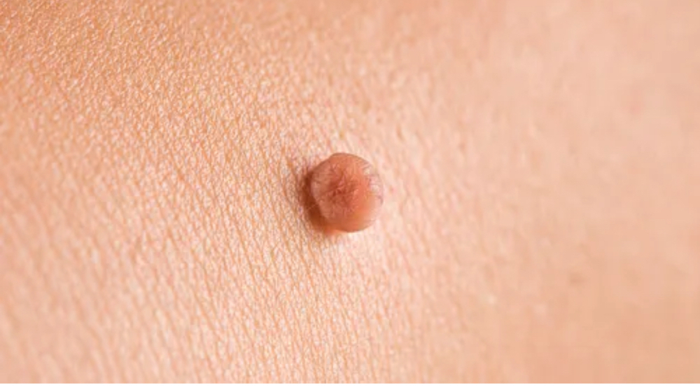 Skin tag, mole, etc. removal