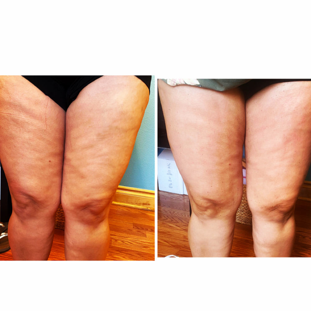 Cellulite Reduction at 210 The Body Bar | San Antonio Lux Spray Tans & Body Sculpting in San Antonio, TX