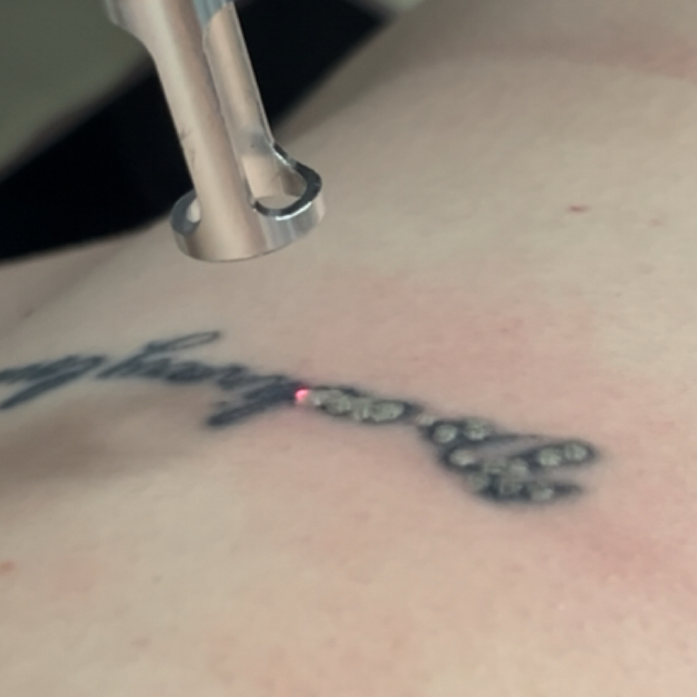 Tattoo Removal Waitlist at House of Pearls Aesthetics LLC in Las Vegas, NV