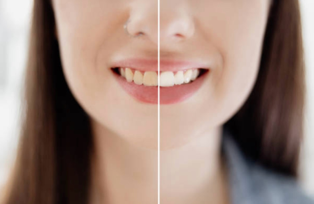 Teeth Whitening