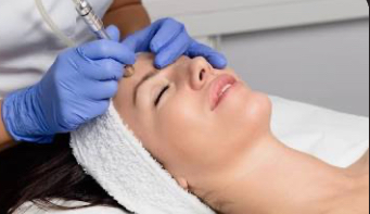 Microdermabrasion