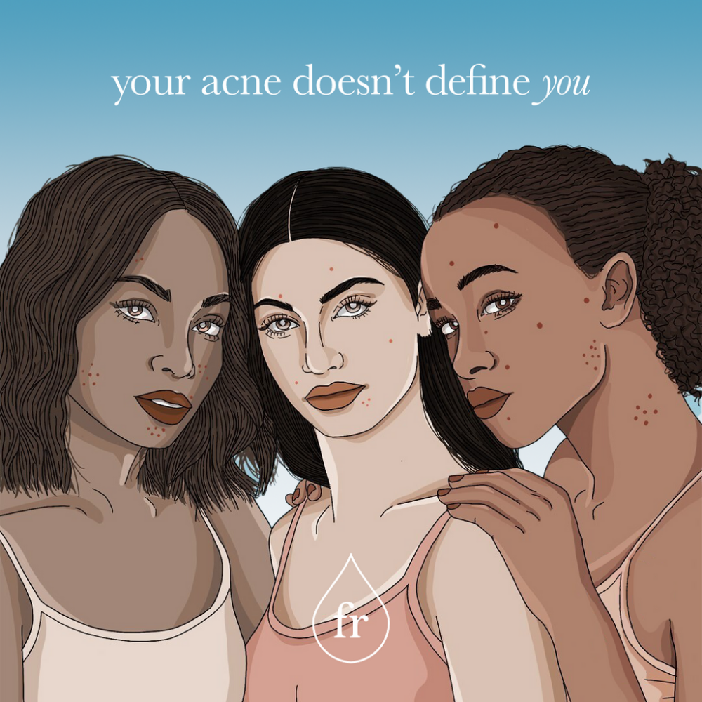 New Acne client consultation