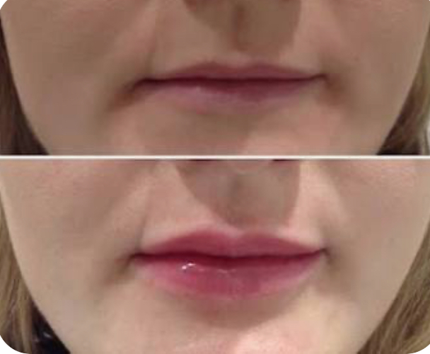 Needless Lip Filler 0.5 ML at Ash N Aura in Crofton, MD