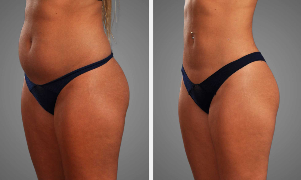 LIPO SCULPTING CAVITATION at Rouge & Co. Salon in Sumiton, AL