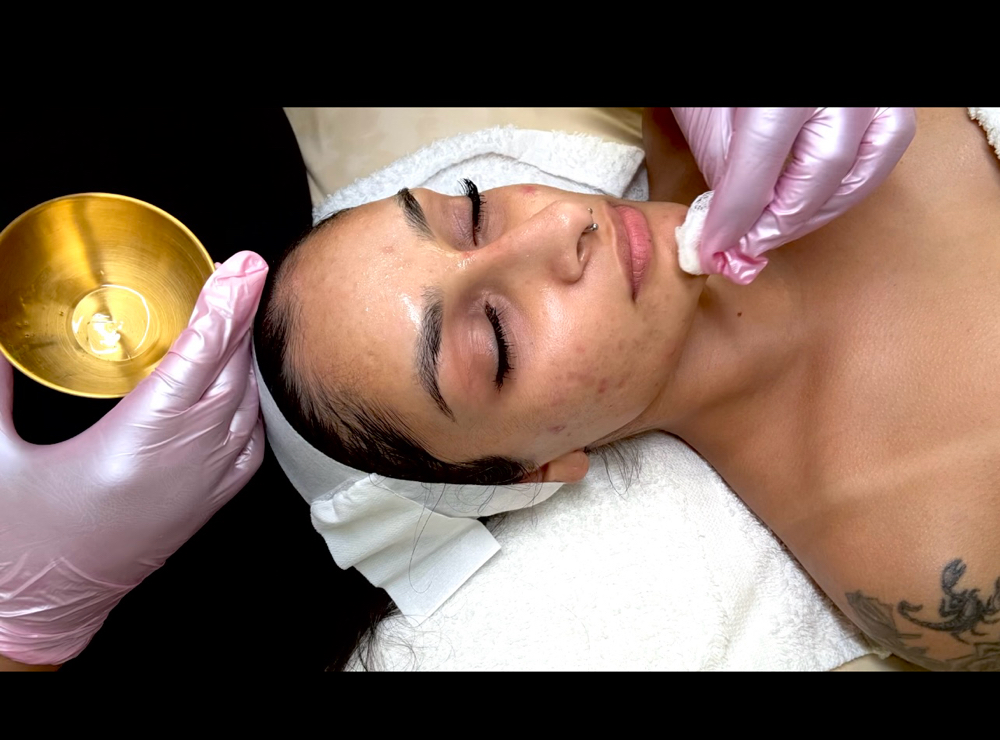 Chemical Peel (ADD-ON)