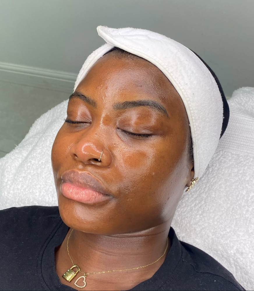 Microneedling Facial