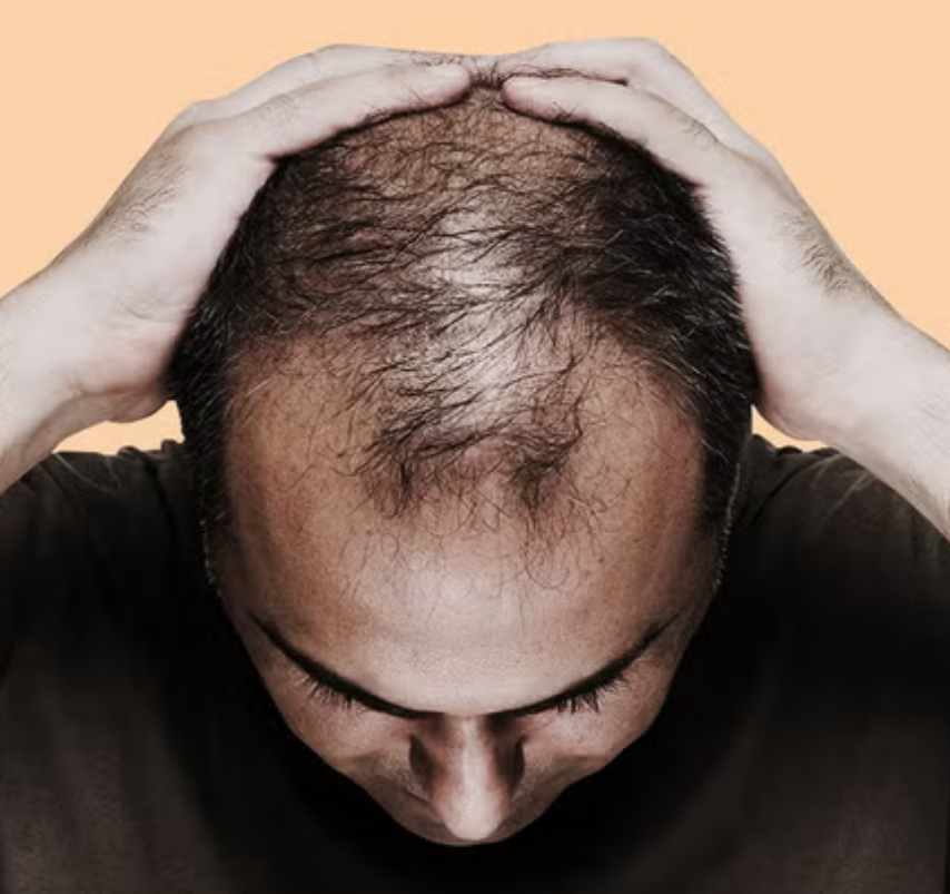 Follicley Challenged Cut