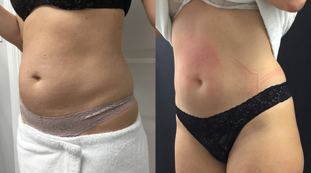 Emsculpt Neo Package