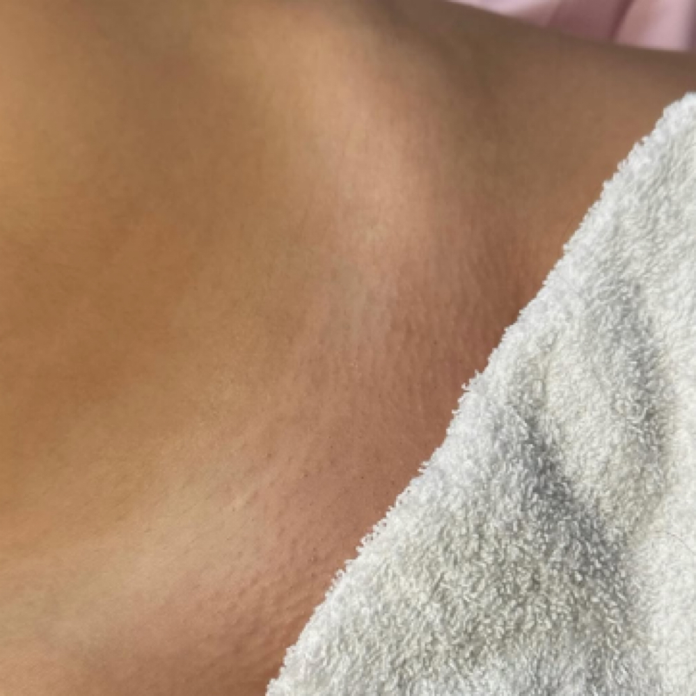 Brazilian Waxing at Skin Academy in New Bedford, MA