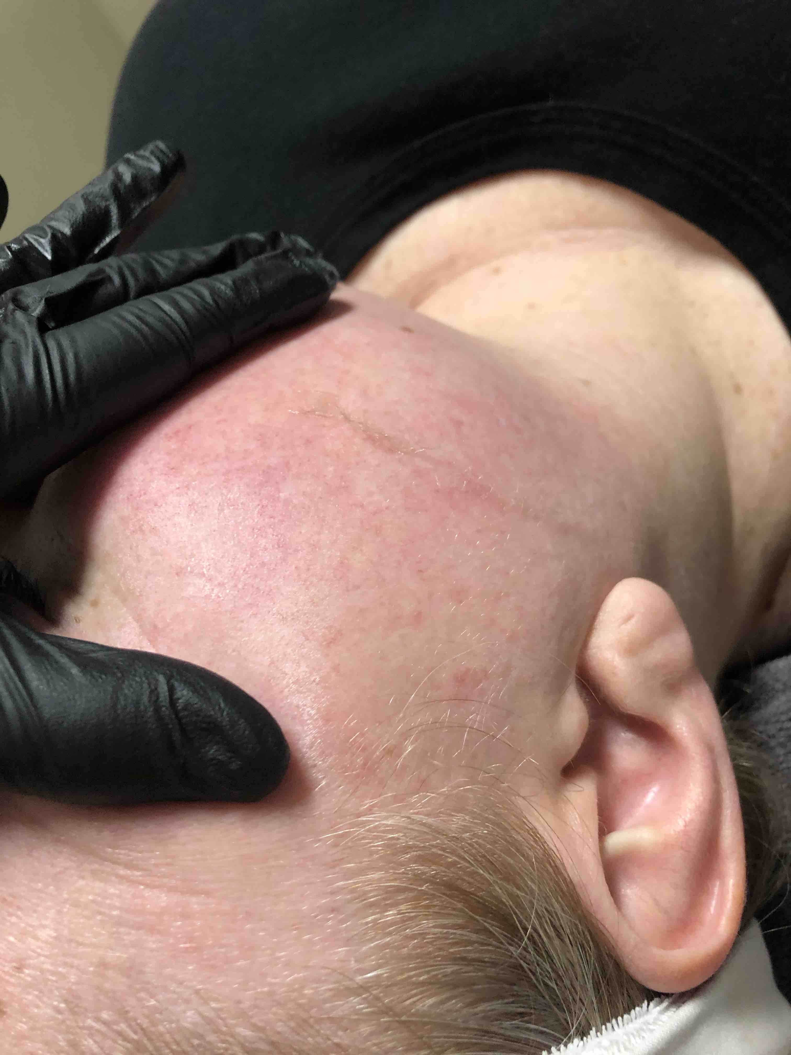 Dermaplanig Facail