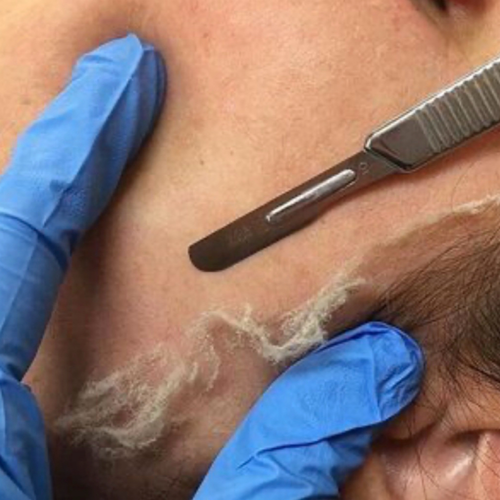 Dermaplaning Add-on at Revitalize Health in Florence, SC