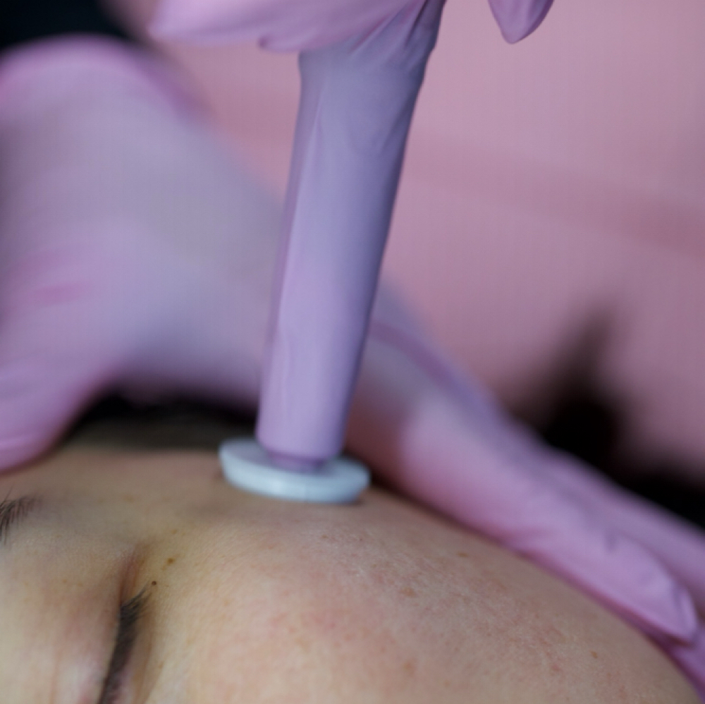 MicroChanneling at Skin Studio 57 in Woburn, MA