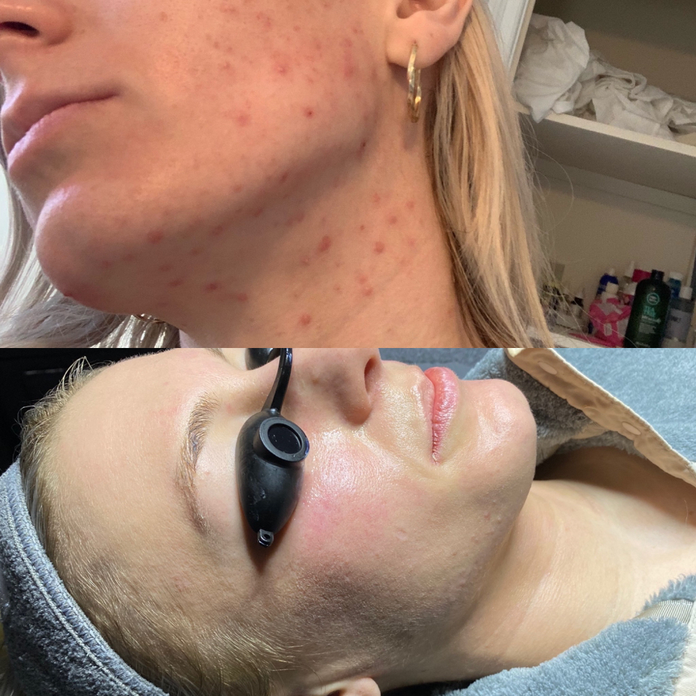 Acne Consult + Facial