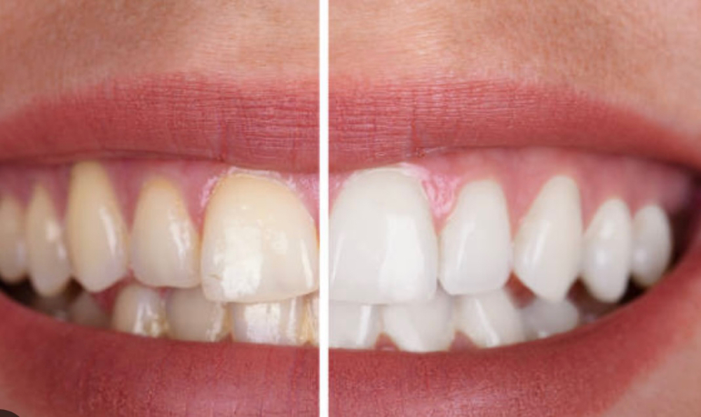 TeethWhitening