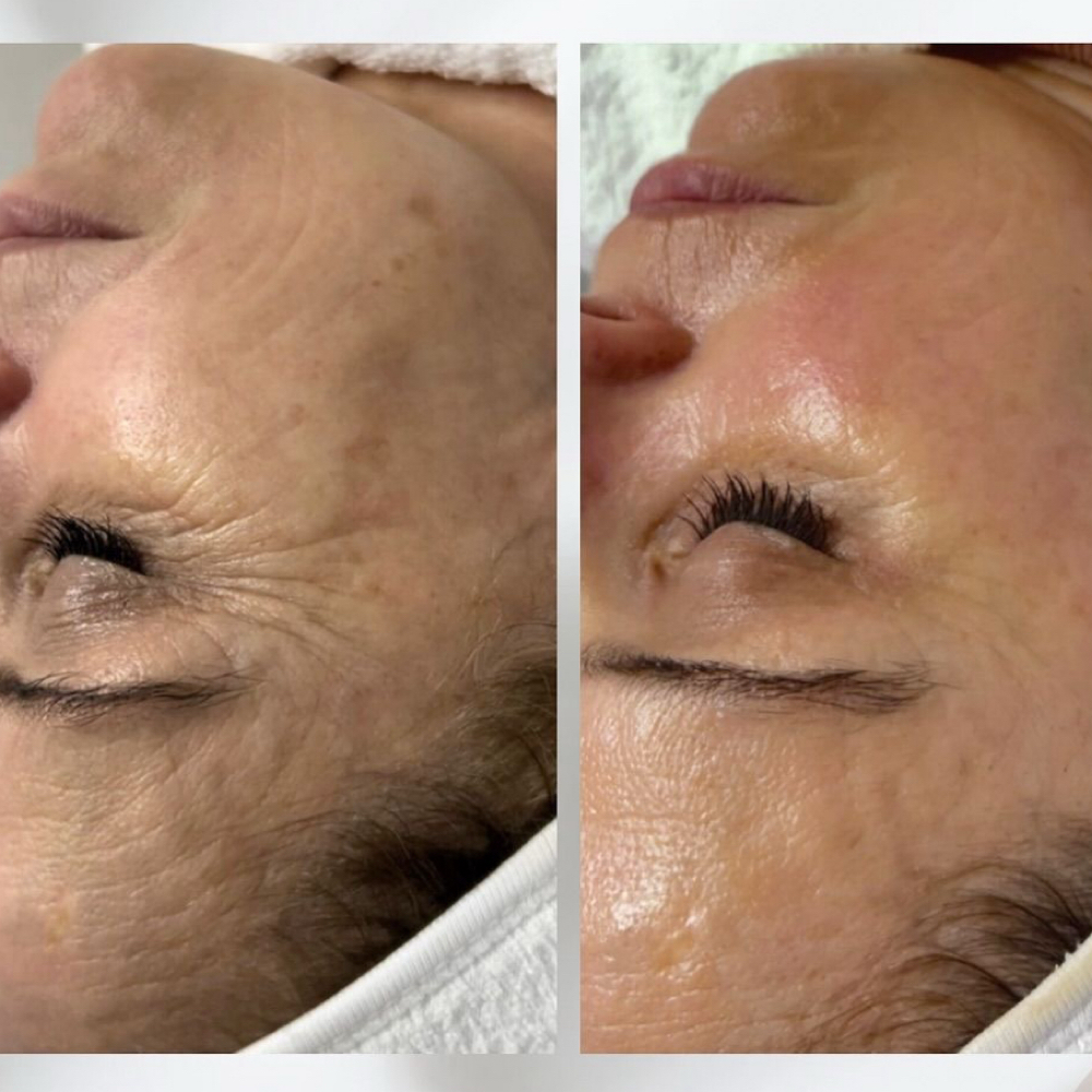 VTox Facial at Estheva Aesthetics in Richland, WA