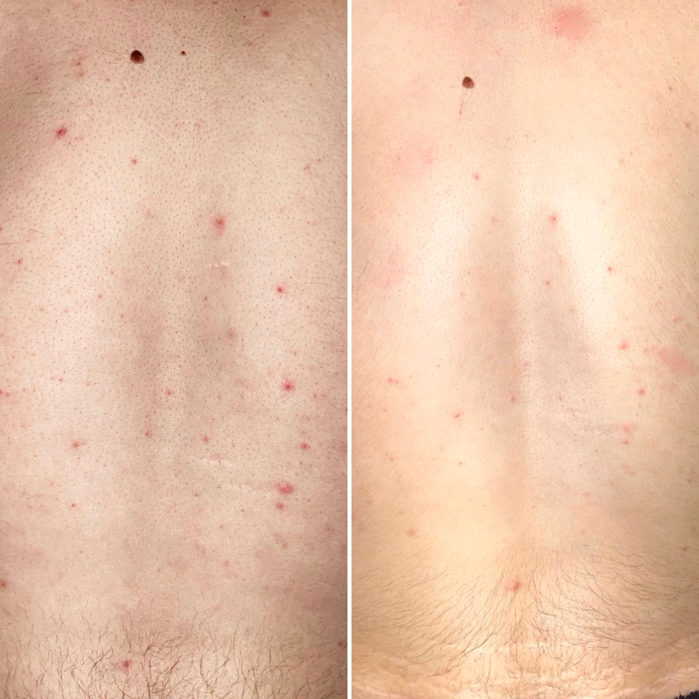 Back Treatment