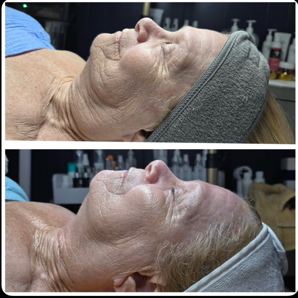 Basic SWICH Dermal Revitalization at Haylee Jade Esthetics LLC in Ellijay, GA