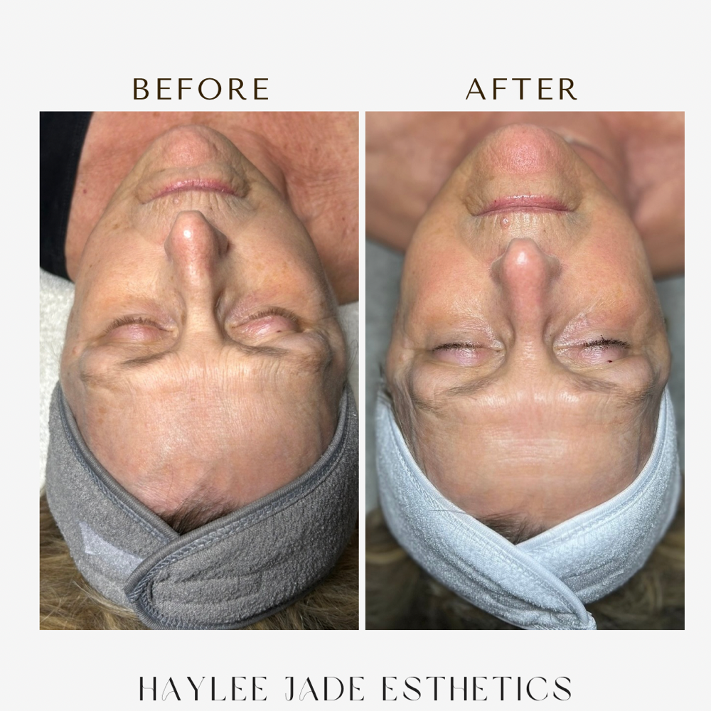 Basic SWICH Dermal Revitalization