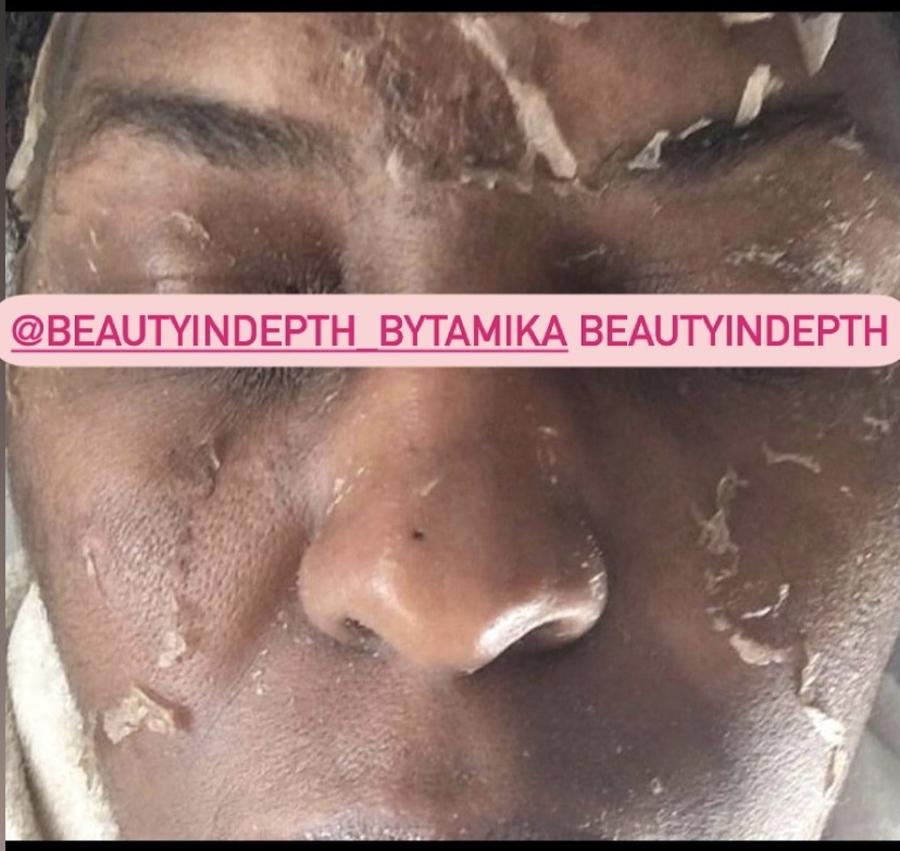 AHA/BHA PEEL (single Peel)