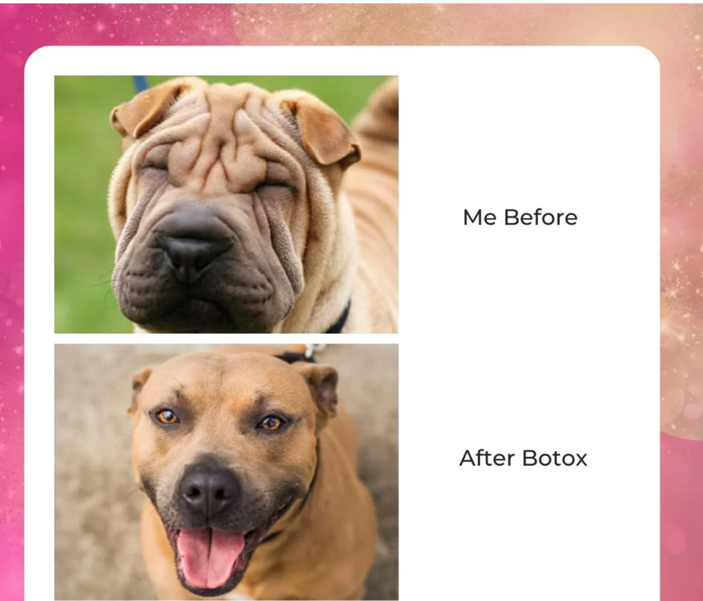 Botox (Full face)