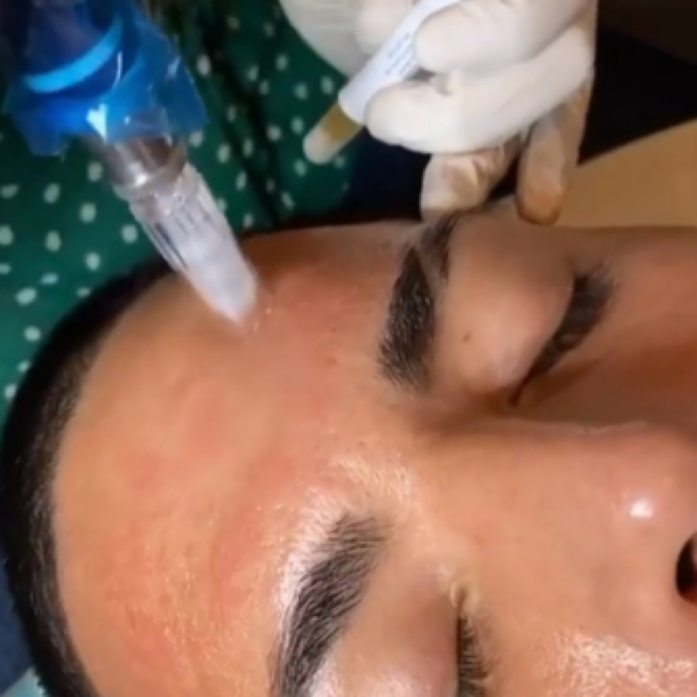 Rejuvapen Microneedling at Acnessia Laser Clinic in Guaynabo, PR