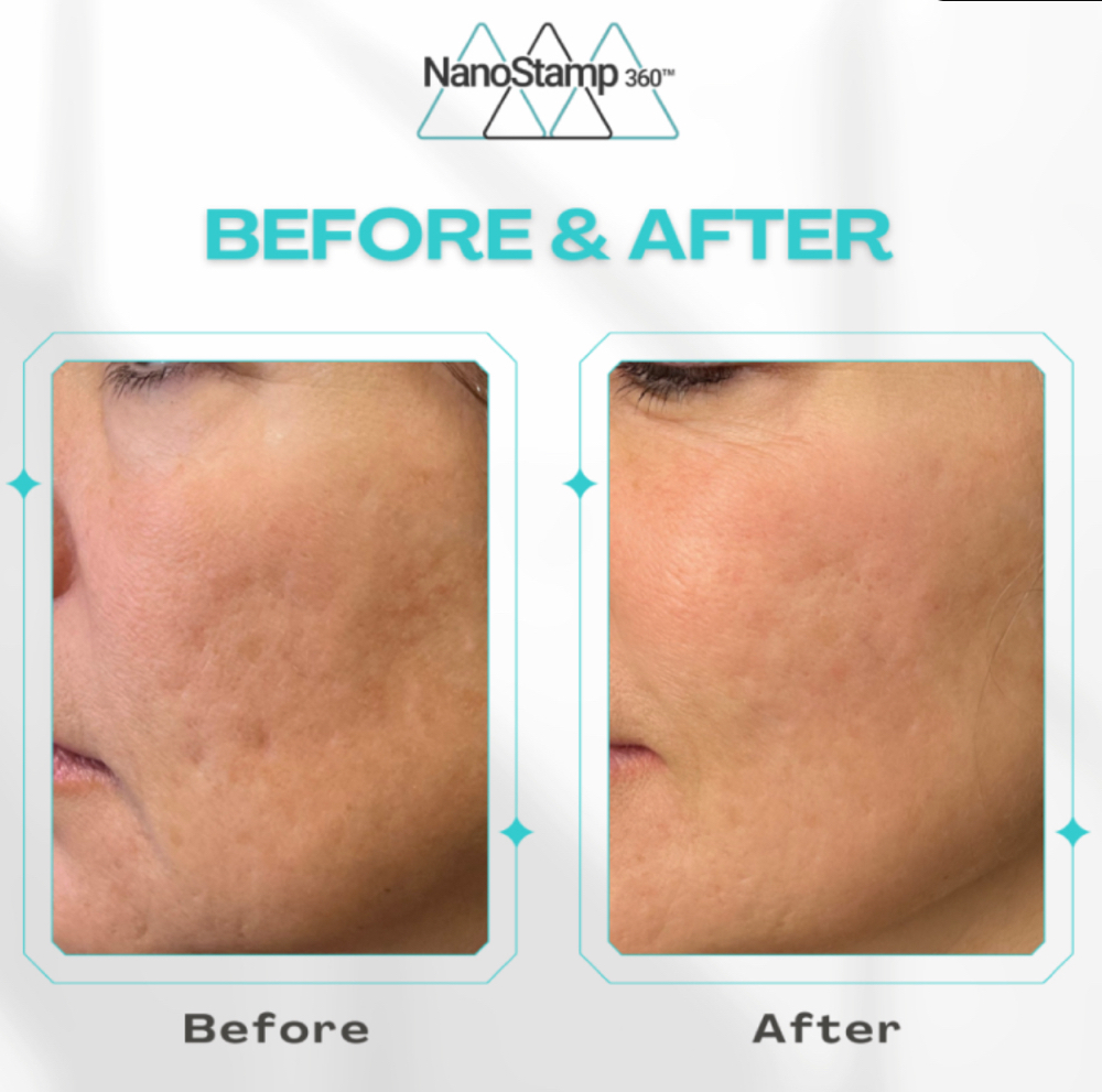 Microneedling