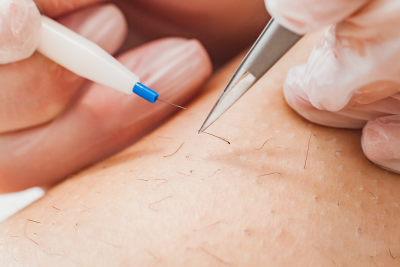 Permanent Hair Removal