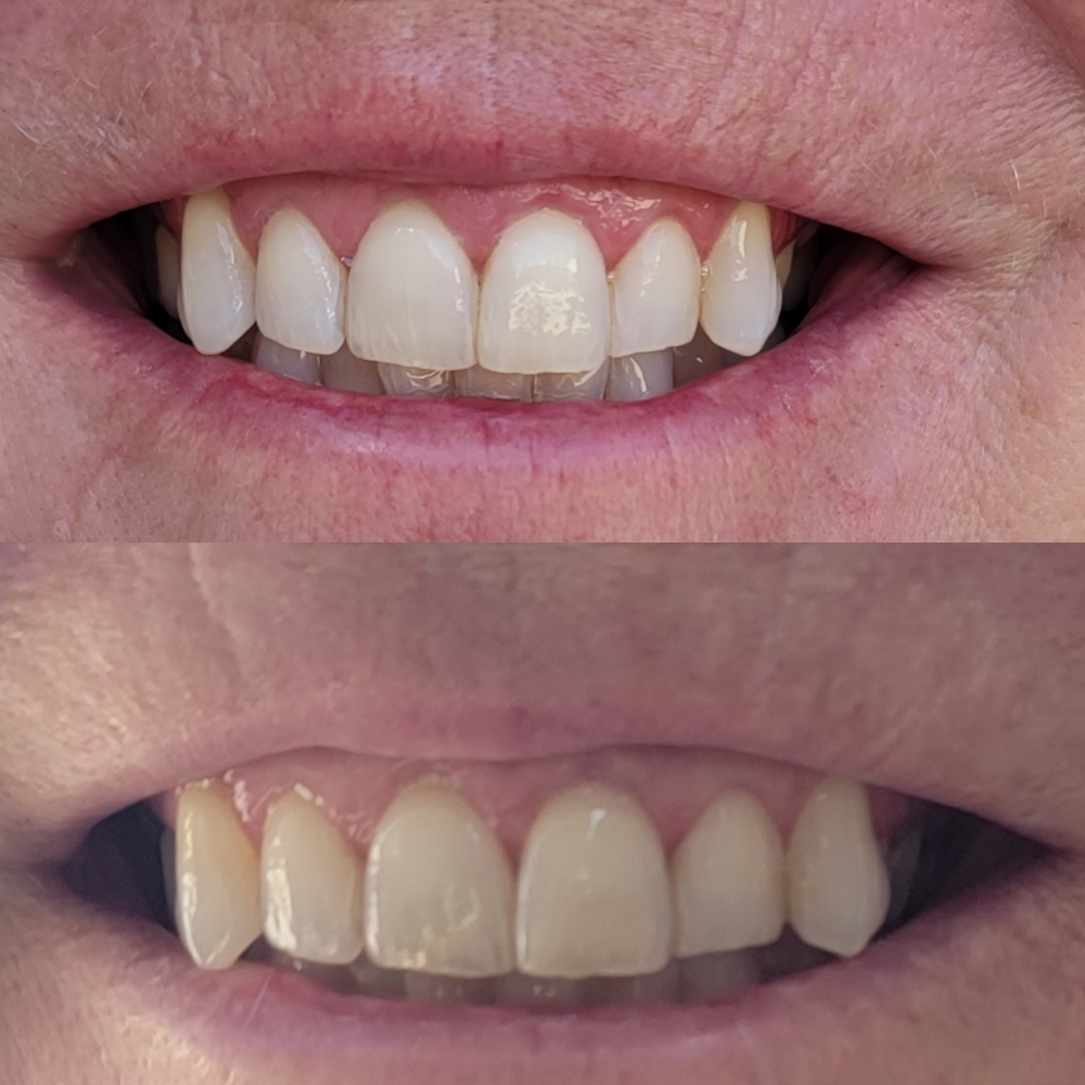 Teeth Whitening