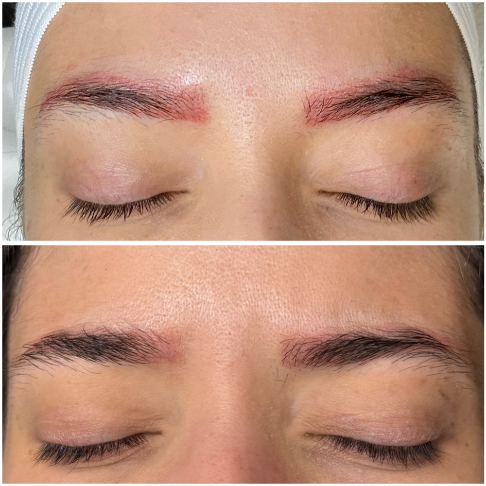 Package of 3 saline removal session at Katie Beauty in Walnut Creek, CA