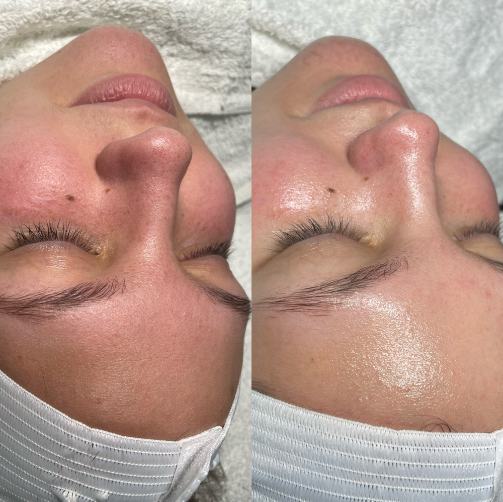 Microdermabrasion