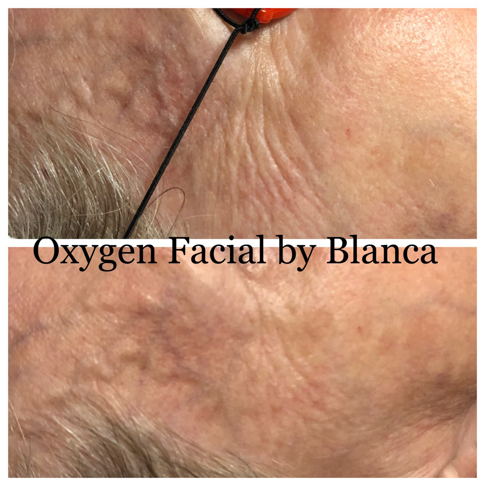 Micro-Oxygen Facial