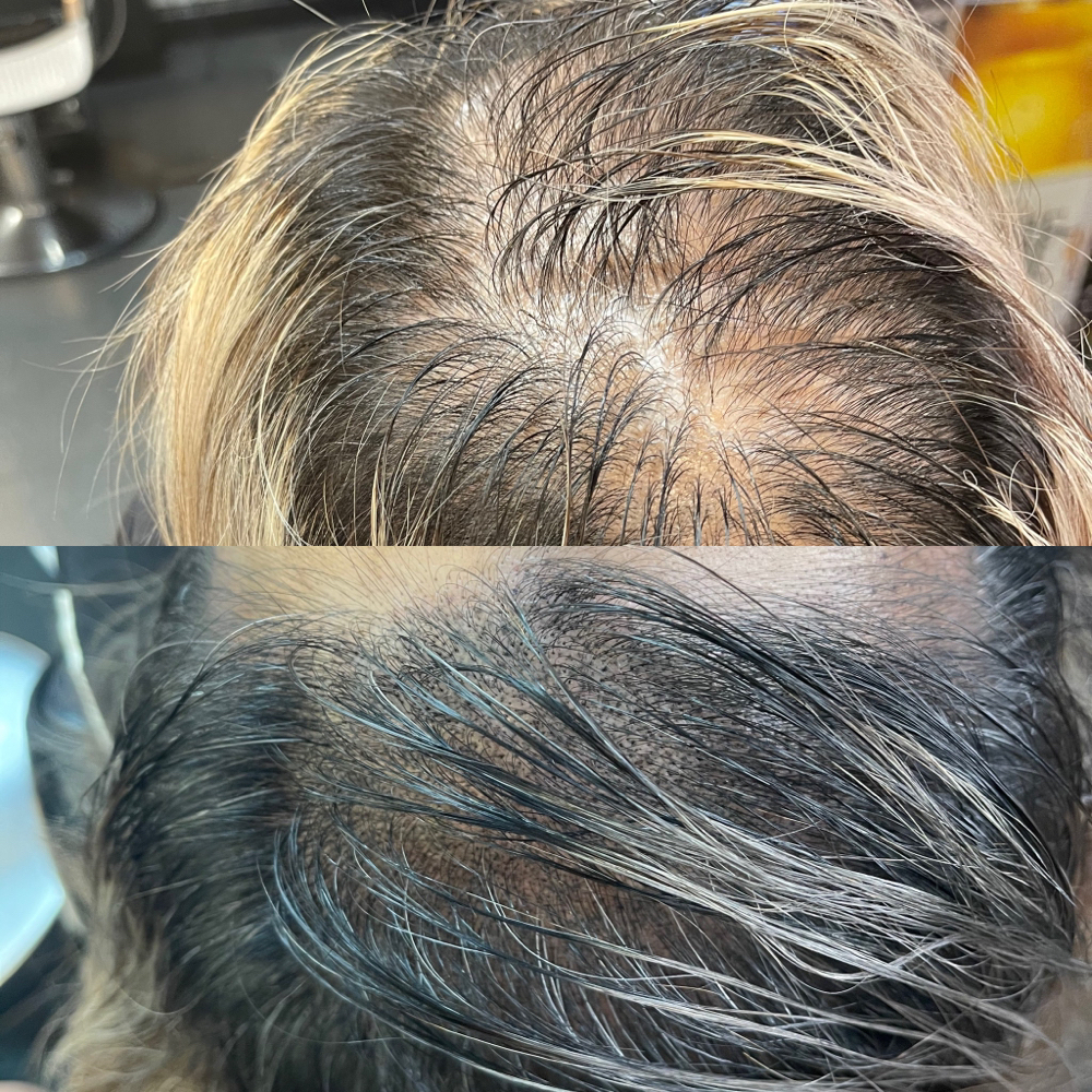 Woman Scalp Micropigmentation Sesh