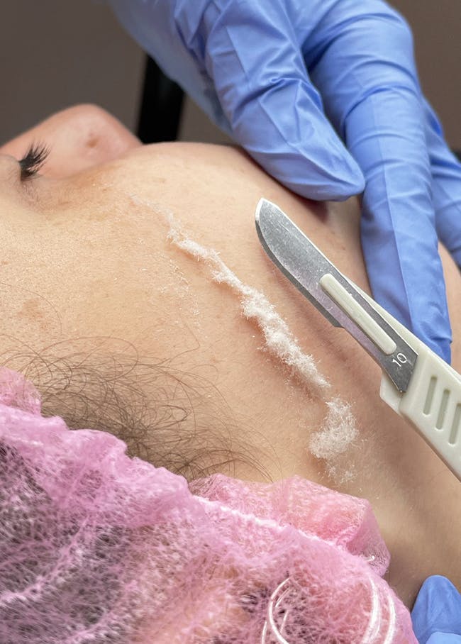 Dermaplaning