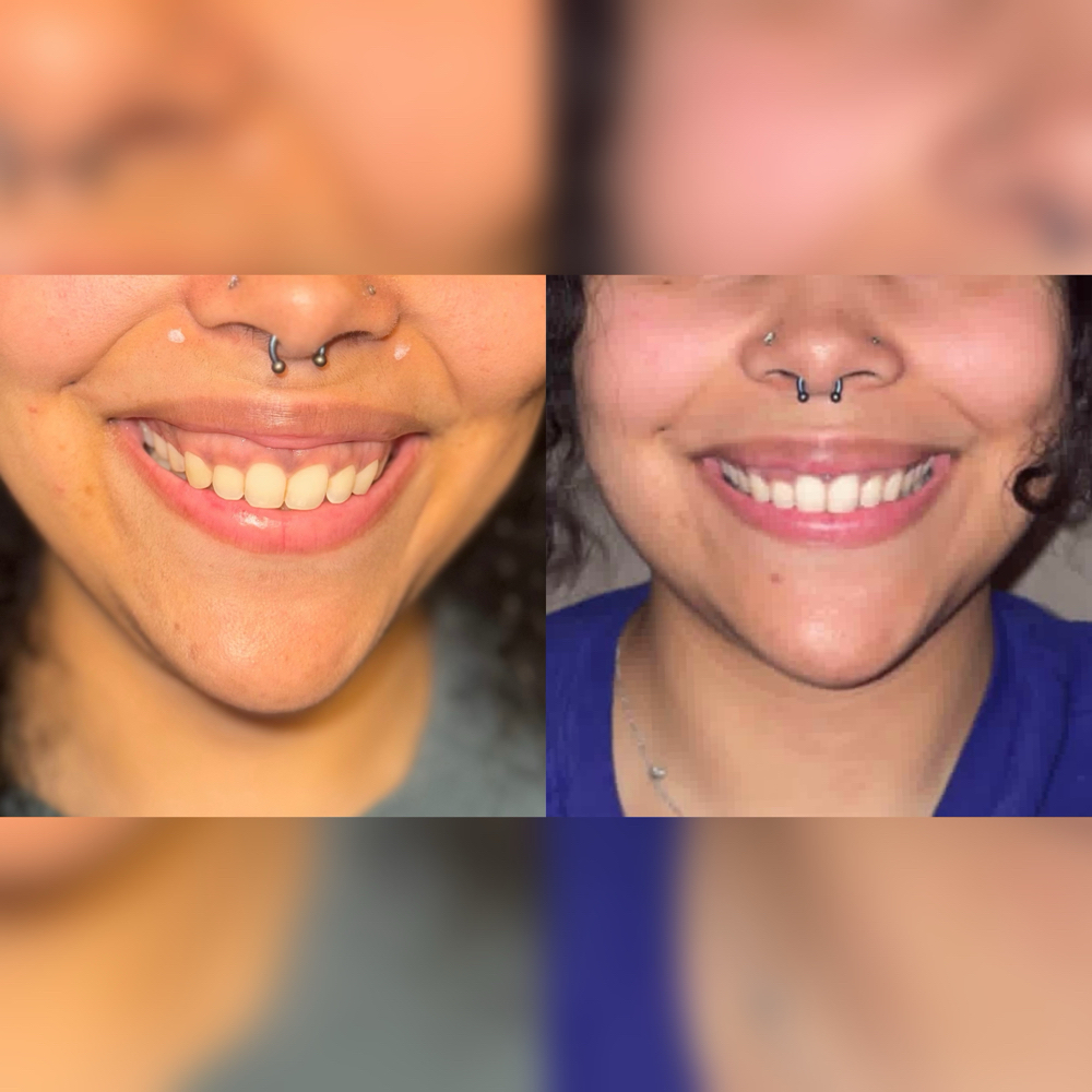 Gummy Smile Correction at The Filler Lounge in Cypress, TX