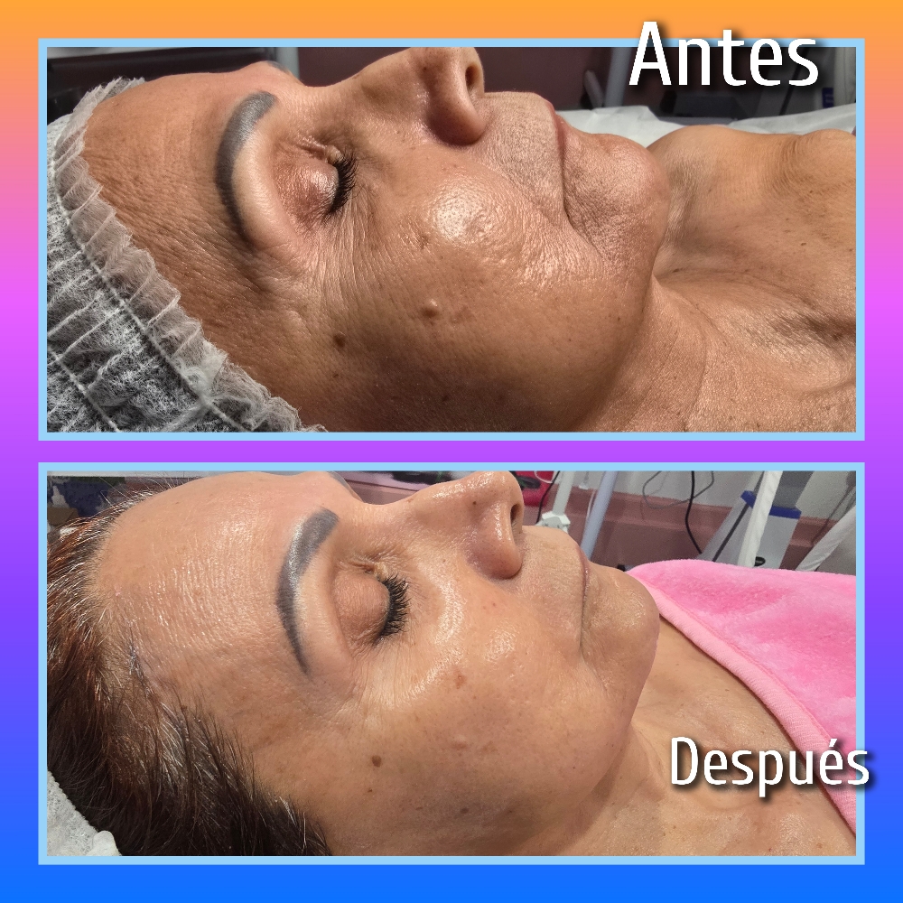 Yesoterapia Facial