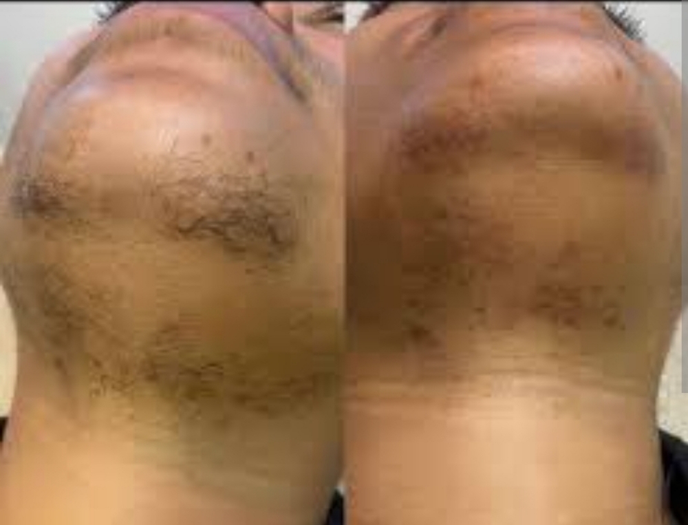Chin Wax