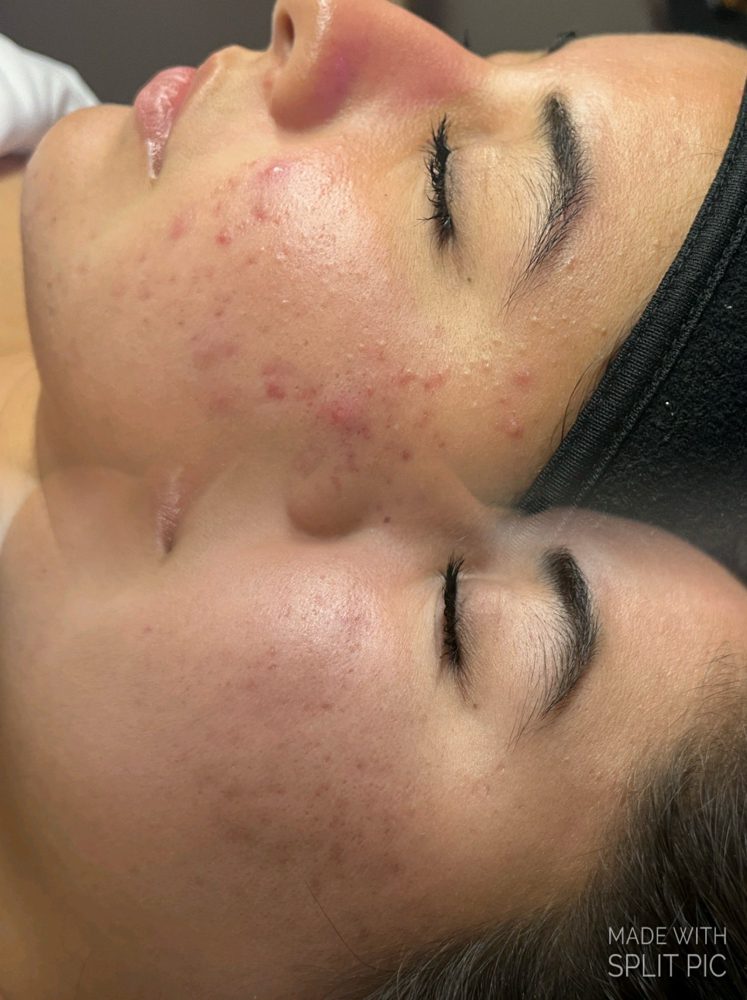 Consultation + Acne Treatment