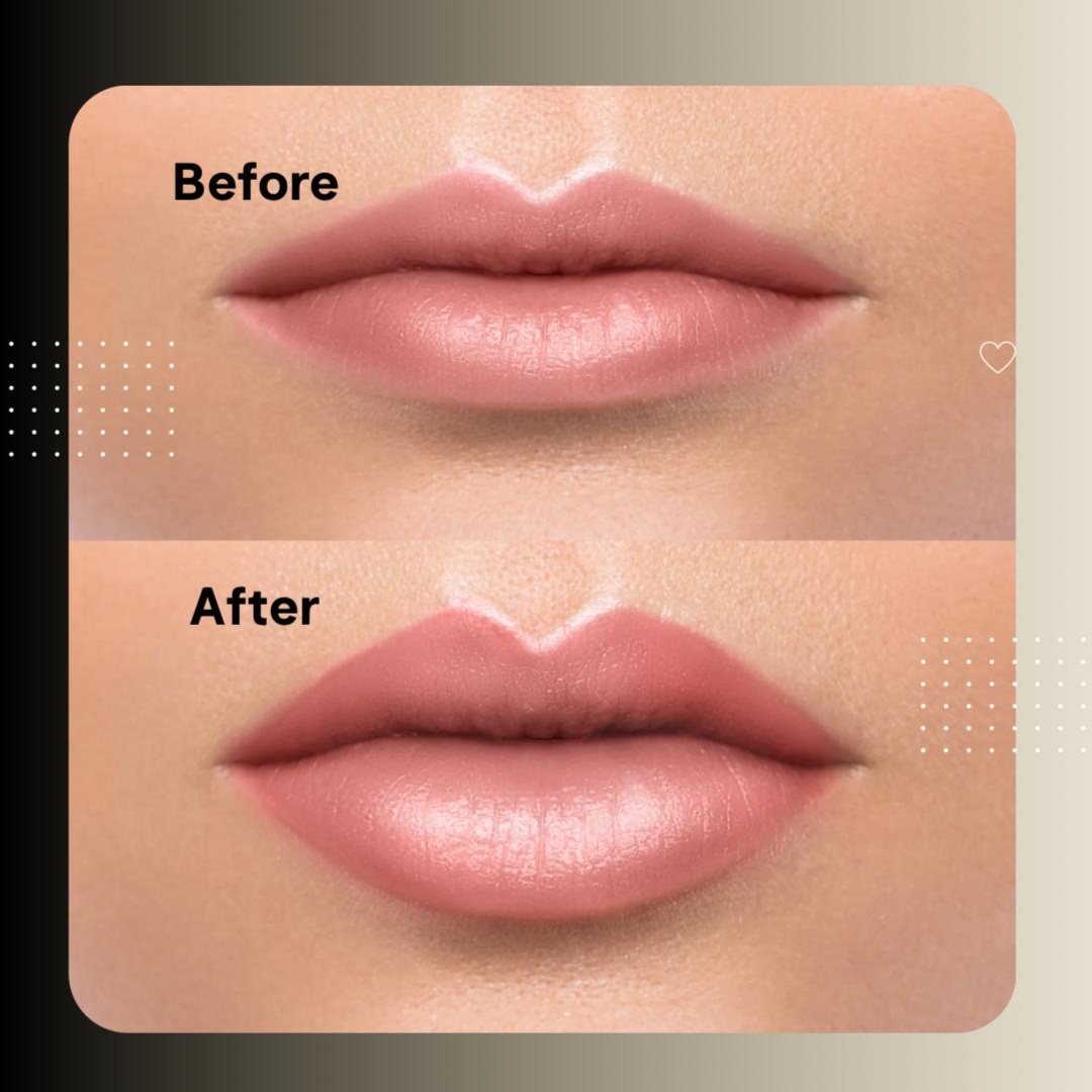 Lip Flip (Top & Bottom) at Glam & Glow MedSpa in Plano, TX