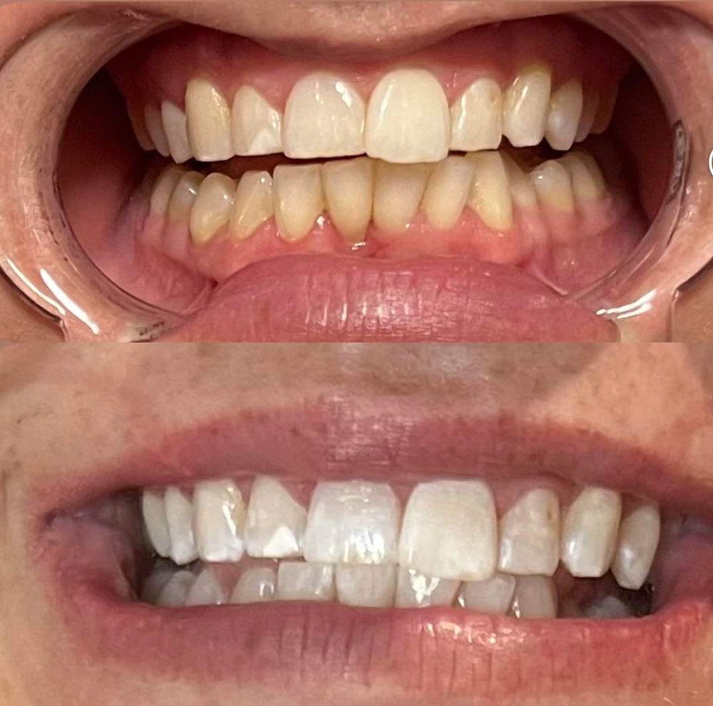 Teeth Whitening Touch Up