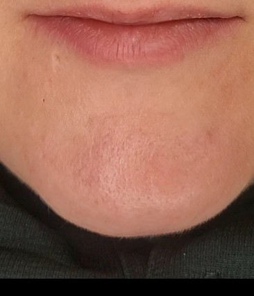 Chin Waxing