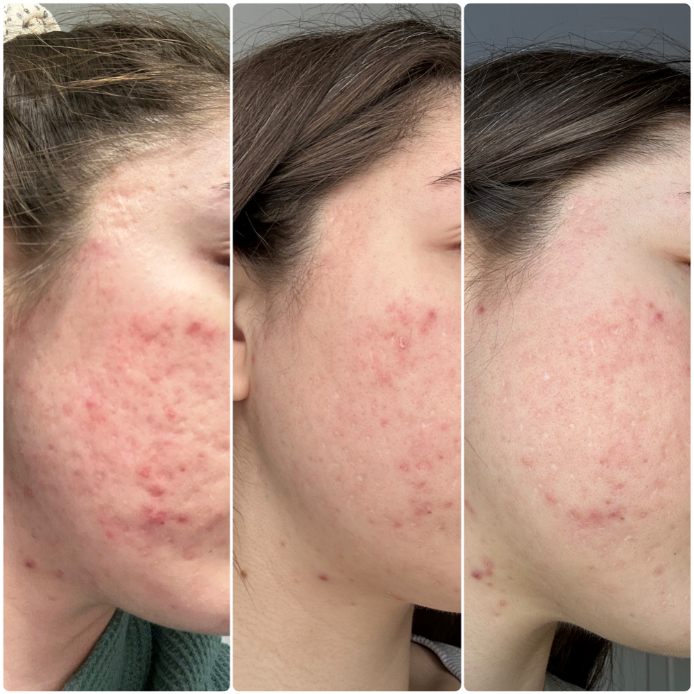 ULTIMATE SKIN RESET - LEVEL 3 at D.Esthetixs Beauty + Skin in Nanuet, NY