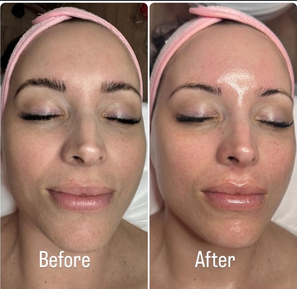 Hydrodermabrasion